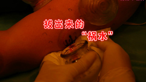 警示!去拔罐拔出来这一滩东西,一定要及早处理!